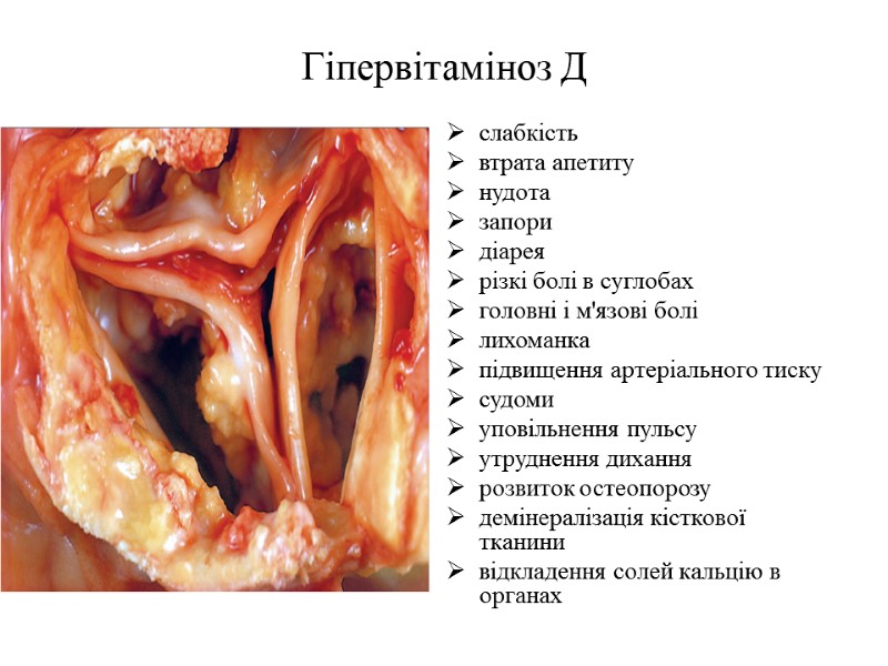 Гіпервітаміноз Д слабкість втрата апетиту нудота запори діарея різкі болі в суглобах головні і